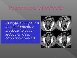  La vejiga se regenera
muy lentamente y
produce fibrosis y
reducción de la
capacidad vesical.
 