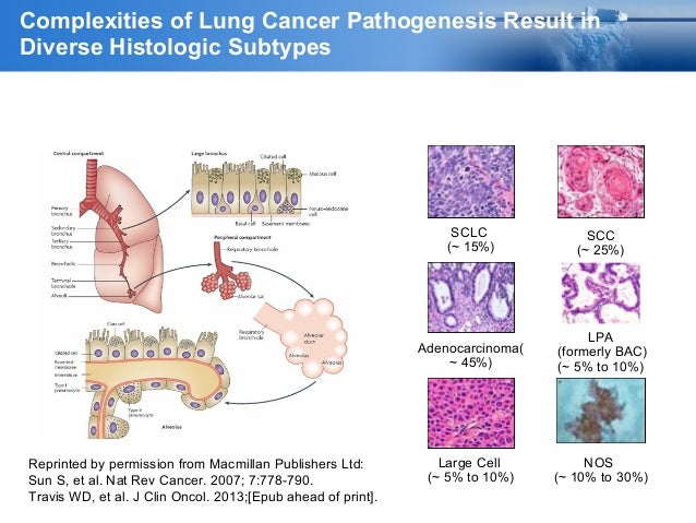 CES 2016 02 - Lung Cancer