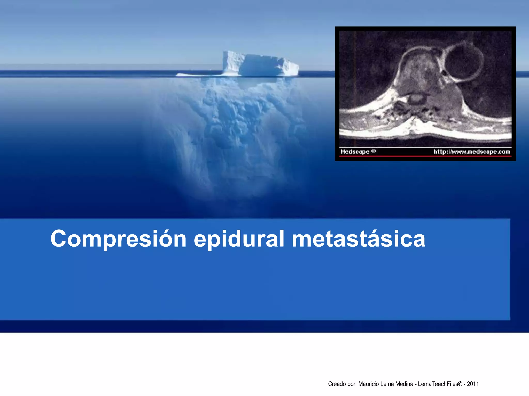 Compresión epidural metastásica
Creado por: Mauricio Lema Medina - LemaTeachFiles© - 2011
 