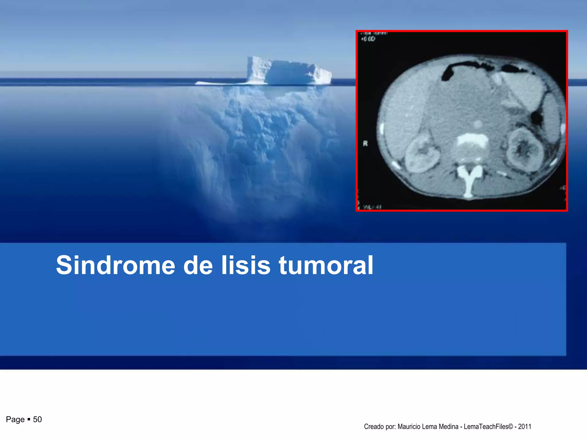 Sindrome de lisis tumoral
Page  50
Creado por: Mauricio Lema Medina - LemaTeachFiles© - 2011
 