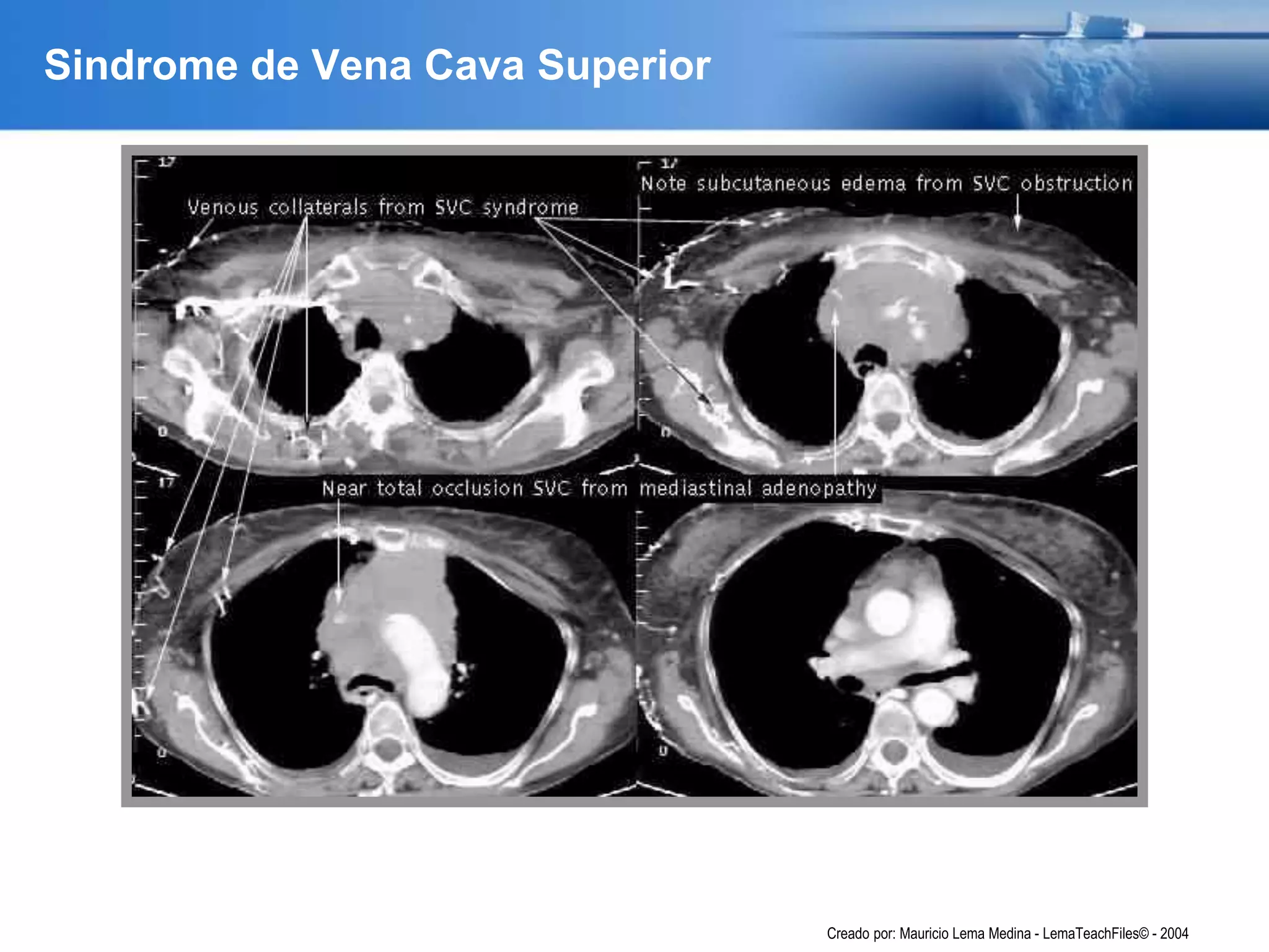 Sindrome de Vena Cava Superior
Creado por: Mauricio Lema Medina - LemaTeachFiles© - 2004
 