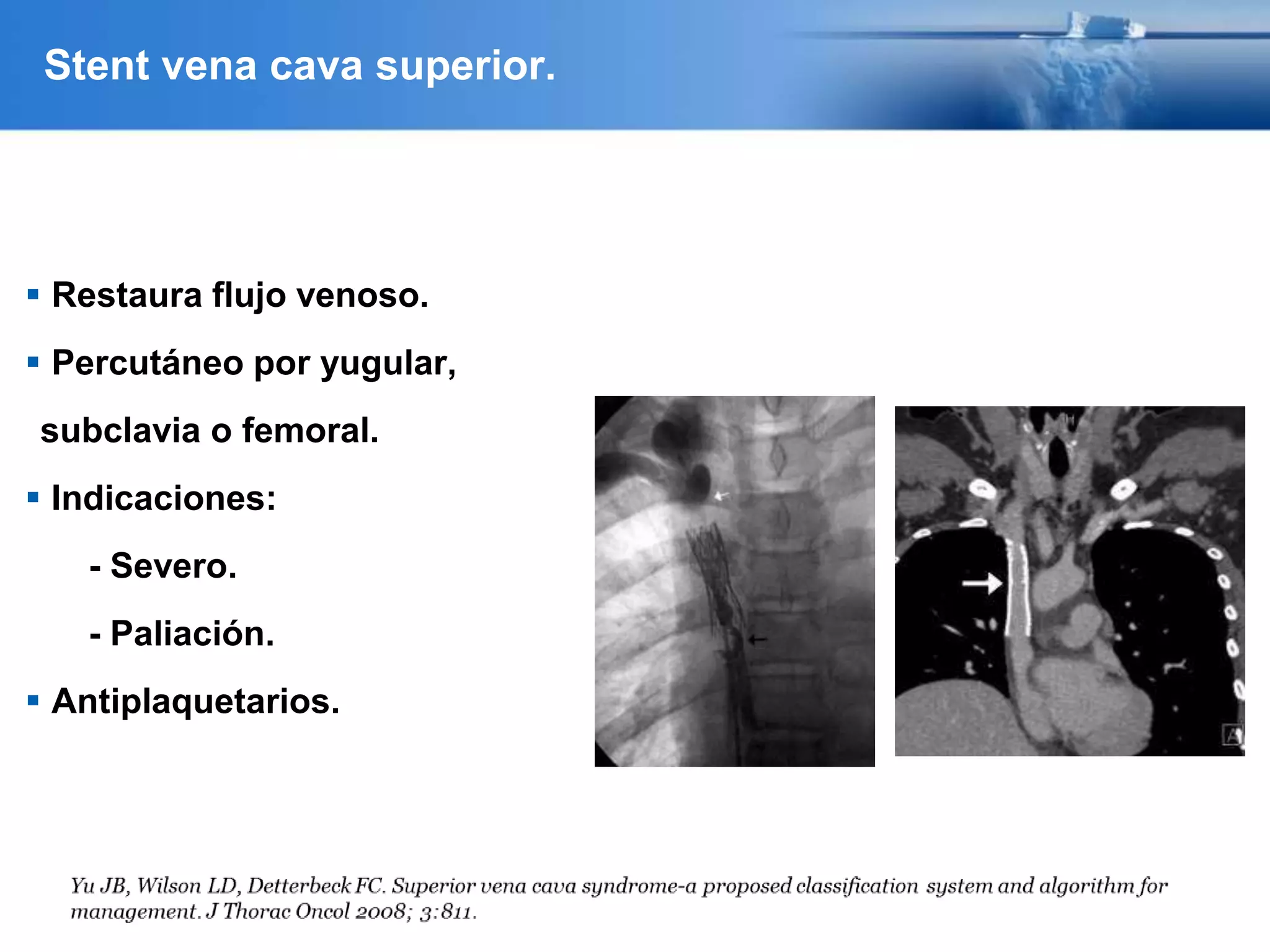 Stent vena cava superior.
 Restaura flujo venoso.
 Percutáneo por yugular,
subclavia o femoral.
 Indicaciones:
- Severo.
- Paliación.
 Antiplaquetarios.
 