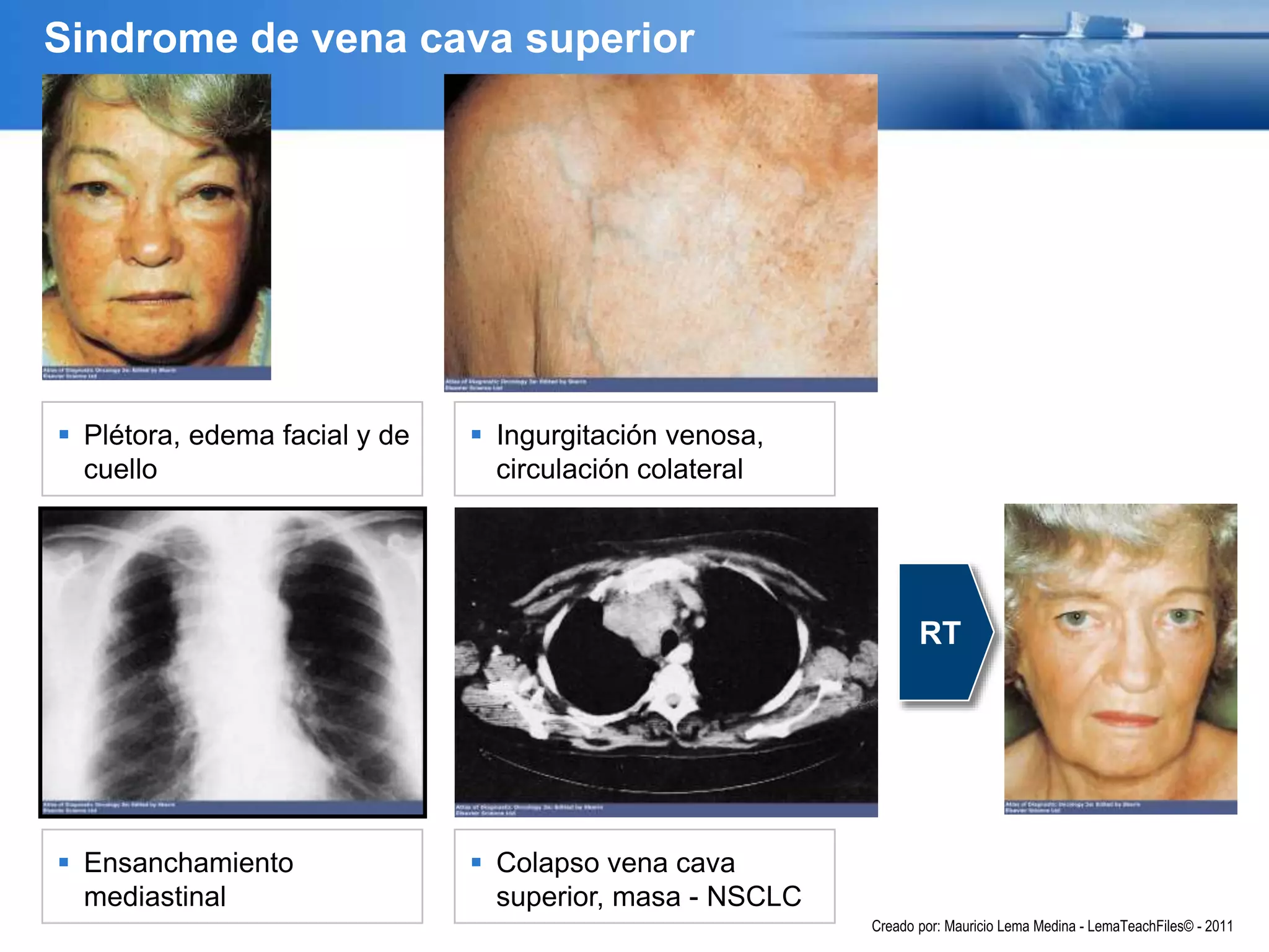 Creado por: Mauricio Lema Medina - LemaTeachFiles© - 2011
RT
 Plétora, edema facial y de
cuello
 Ingurgitación venosa,
circulación colateral
 Ensanchamiento
mediastinal
 Colapso vena cava
superior, masa - NSCLC
Sindrome de vena cava superior
 