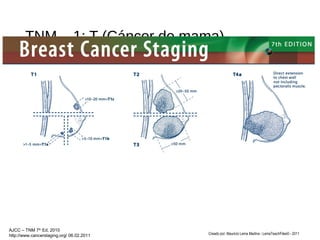 TNM – 1: T (Cáncer de mama)
Creado por: Mauricio Lema Medina - LemaTeachFiles© - 2011
AJCC – TNM 7th
Ed, 2010
http://www.cancerstaging.org/ 06.02.2011
 