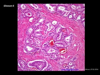 Gleason 6
www.cancernetwork.com - Cesar A Moran, 07.02.2014
 