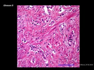 Gleason 9
www.cancernetwork.com - Cesar A Moran, 07.02.2014
 