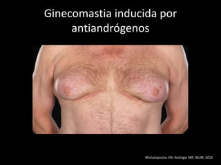 Ginecomastia inducida por
antiandrógenos
Michalopoulus VN, Keshtgar MR, NEJM, 2012
 