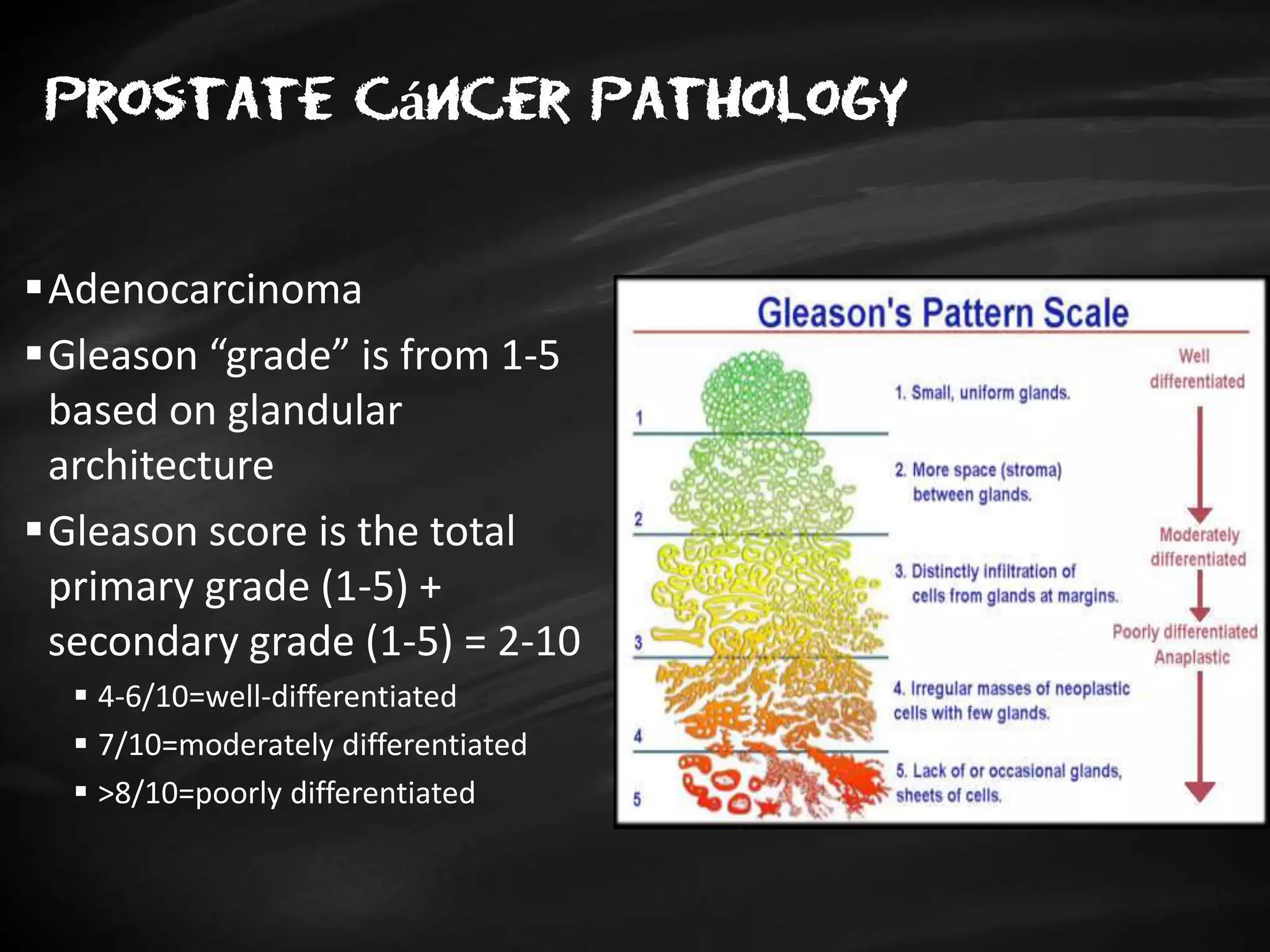 Prostate Grade CES2018-01: Cáncer de próstata | PPTX