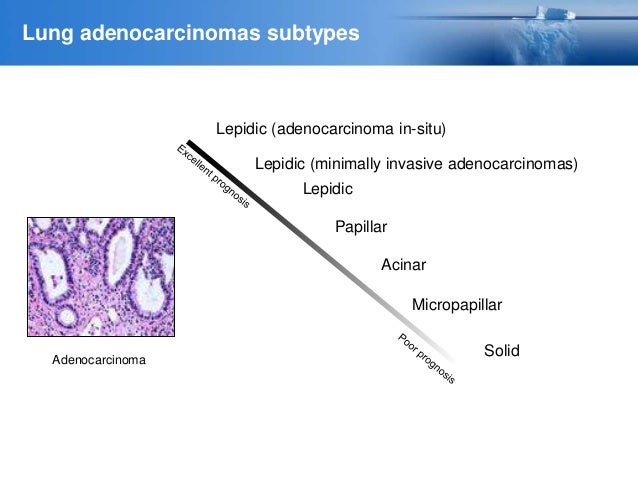 Ces18 02 Cancer De Pulmon Clases 1 Y 2