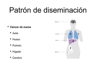 Patrón de diseminación
• Cáncer de mama
• Axila
• Hueso
• Pulmón
• Hígado
• Cerebro
1
2
3
4
5
 