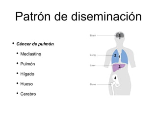 Patrón de diseminación
• Cáncer de pulmón
• Mediastino
• Pulmón
• Hígado
• Hueso
• Cerebro
1
4
2
3
5
 