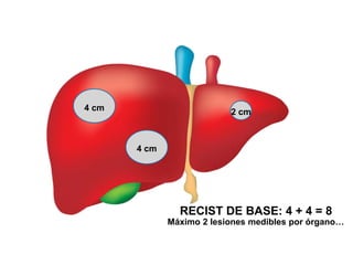 4 cm
4 cm
2 cm
RECIST DE BASE: 4 + 4 = 8
Máximo 2 lesiones medibles por órgano…
 