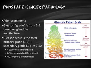 Prostate cáncer pathology
Adenocarcinoma
Gleason “grade” is from 1-5
based on glandular
architecture
Gleason score is the total
primary grade (1-5) +
secondary grade (1-5) = 2-10
 4-6/10=well-differentiated
 7/10=moderately differentiated
 >8/10=poorly differentiated
 
