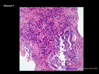 Gleason 7
www.cancernetwork.com - Cesar A Moran, 07.02.2014
 