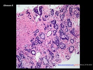 Gleason 8
www.cancernetwork.com - Cesar A Moran, 07.02.2014
 