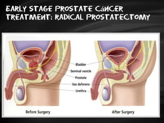 Early stage Prostate cáncer
treatment: radical prostatectomy
 