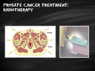 Prosate cancer treatment:
radiotherapy
 