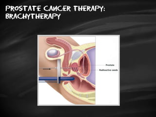 Prostate cancer therapy:
brachytherapy
 