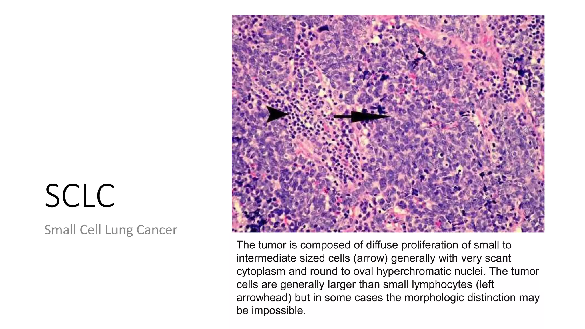 SCLC
Small Cell Lung Cancer
The tumor is composed of diffuse proliferation of small to
intermediate sized cells (arrow) generally with very scant
cytoplasm and round to oval hyperchromatic nuclei. The tumor
cells are generally larger than small lymphocytes (left
arrowhead) but in some cases the morphologic distinction may
be impossible.
 