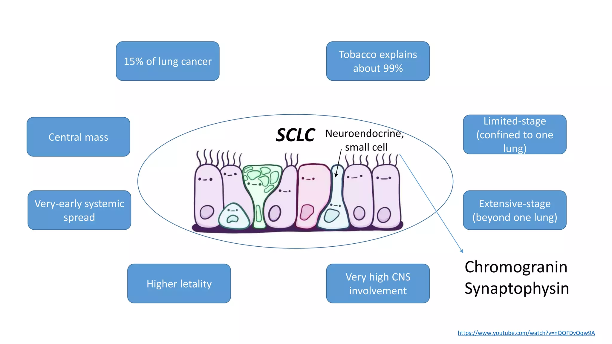 15% of lung cancer
Central mass
Very-early systemic
spread
Higher letality
Tobacco explains
about 99%
Limited-stage
(confined to one
lung)
Extensive-stage
(beyond one lung)
Very high CNS
involvement
SCLC
https://www.youtube.com/watch?v=nQQFDvQqw9A
Neuroendocrine,
small cell
Chromogranin
Synaptophysin
 