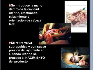 Se introduce la mano dentro de la cavidad uterina, efectuando calzamiento y orientación de cabeza fetal<br />Se retira val...