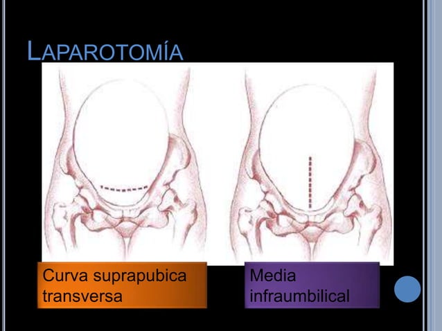 Cesara y tipos de cesareas indicaciones y contraindicaciones