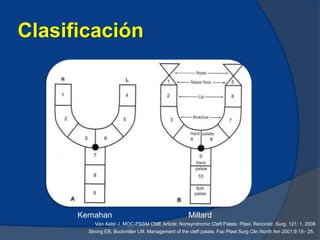 Palatoplastia | PPTX