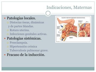 Indicaciones, Maternas

 Patologías locales.
   Distocias óseas, dinámicas
   y de partes blandas.
   Rotura uterina.
   Infecciones genitales activas.

 Patologías sistémicas.
   Preeclampsia.
   Hipertensión crónica
   Tuberculosis pulmonar grave.

 Fracaso de la inducción.
 