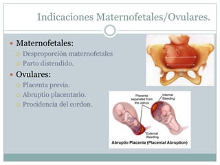 Indicaciones Maternofetales/Ovulares.

 Maternofetales:
   Desproporción maternofetales

   Parto distendido.

 Ovulares:
   Placenta previa.

   Abruptio placentario.

   Procidencia del cordon.
 