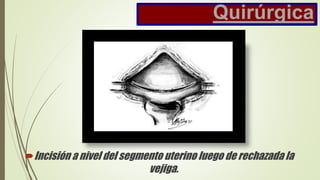 Quirúrgica
Incisión a nivel del segmento uterino luego de rechazada la
vejiga.
 