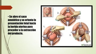 • Se abre el saco
amniótico y se orienta la
presentación fetal hacia
la herida uterina para
proceder a la extracción
del producto.
 