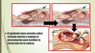 El ayudante hace presión sobre
el fondo uterino y empuja la
presentación para facilitar la
extracción de la cabeza.
 