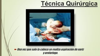 Técnica Quirúrgica
Una vez que sale la cabeza se realiza aspiración de nariz
y orofaringe.
 
