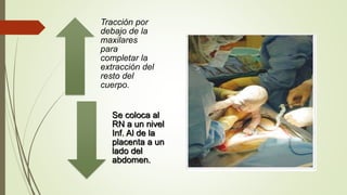 Tracción por
debajo de la
maxilares
para
completar la
extracción del
resto del
cuerpo.
Se coloca al
RN a un nivel
Inf. Al de la
placenta a un
lado del
abdomen.
 