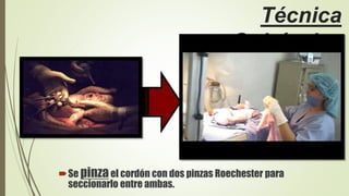 Técnica
Quirúrgica
Se pinzael cordón con dos pinzas Roechester para
seccionarlo entre ambas.
 