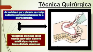 Técnica Quirúrgica
• Es tradicional que la placenta se extraiga
mediante desprendimiento manual de la
inserción uterina.
•Una técnica alternativa es una
tracción suave sobre el cordón
umbilical para lograr un
desprendimiento espontáneo.
 