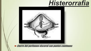 Histerorrafia
Cierre del peritoneo visceral con puntos continuos
 
