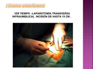 1ER TIEMPO .-LAPAROTOMÍA TRANSVERSA
INFRAUMBILICAL INCISIÓN DE HASTA 15 CM .
 