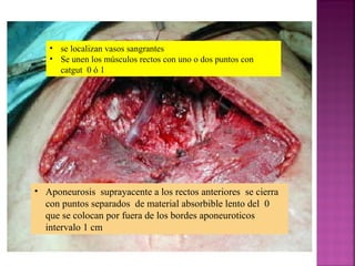 • se localizan vasos sangrantes
• Se unen los músculos rectos con uno o dos puntos con
catgut 0 ó 1
• Aponeurosis suprayacente a los rectos anteriores se cierra
con puntos separados de material absorbible lento del 0
que se colocan por fuera de los bordes aponeuroticos
intervalo 1 cm
 