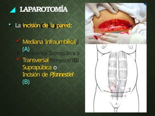 ◢ LAPAROTOMÍA
• La incisión de la pared:
 Mediana Infraumbilical
(A)
 Transversal
Suprapúbica o
Incisión de Pfannestiel
(B)
 