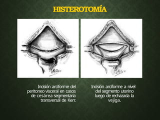 HISTEROTOMÍA
Incisión arciforme del
peritoneo visceral en casos
de cesárea segmentaria
transversal de Kerr
.
Incisión arciforme a nivel
del segmento uterino
luego de rechazada la
vejiga.
 