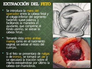 EXTRACCIÓN DEL FETO
• Se introduce la mano del
operador entre la cabeza fetal y
el colgajo inferior del segmento
haciendo suavepalanca, y
facilitando la maniobra el
ayudante, que comprime el
fondouterino, se extrae la
cabeza fetal.
• T
omando ésta entre ambas
manos,como en el nacimiento
vaginal, se extrae el resto del
cuerpo.
• Si el feto se presentara de nalgas
o detronco, se tomará un pie y
se ejecutará la tracción sobre el
mismoextrayéndose por último la
cabeza conmaniobras.
 