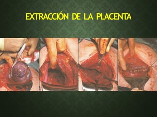 EXTRACCIÓN DE LA PLACENTA
 