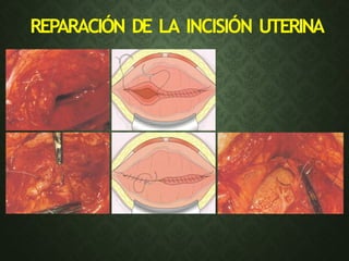 REPARACIÓN DE LA INCISIÓN UTERINA
 