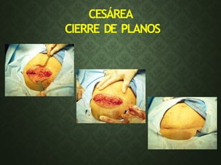 CESÁREA
CIERRE DE PLANOS
 