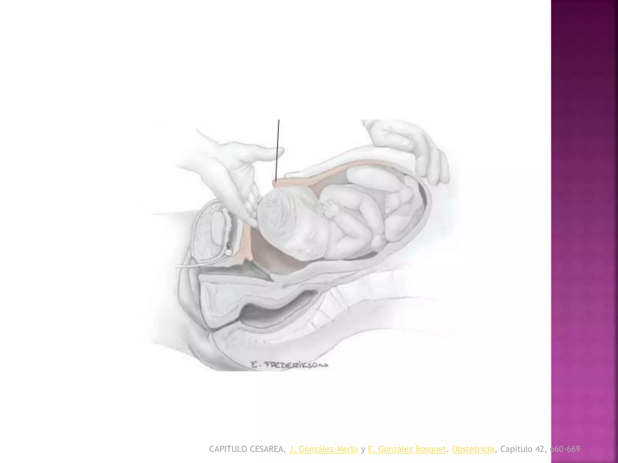 CAPITULO CESAREA, J. González-Merlo y E. González Bosquet. Obstetricia, Capítulo 42, 660-669
EXTRACCION FETAL
 