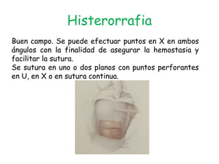 Histerorrafia
Buen campo. Se puede efectuar puntos en X en ambos
ángulos con la finalidad de asegurar la hemostasia y
facilitar la sutura.
Se sutura en uno o dos planos con puntos perforantes
en U, en X o en sutura continua.
 