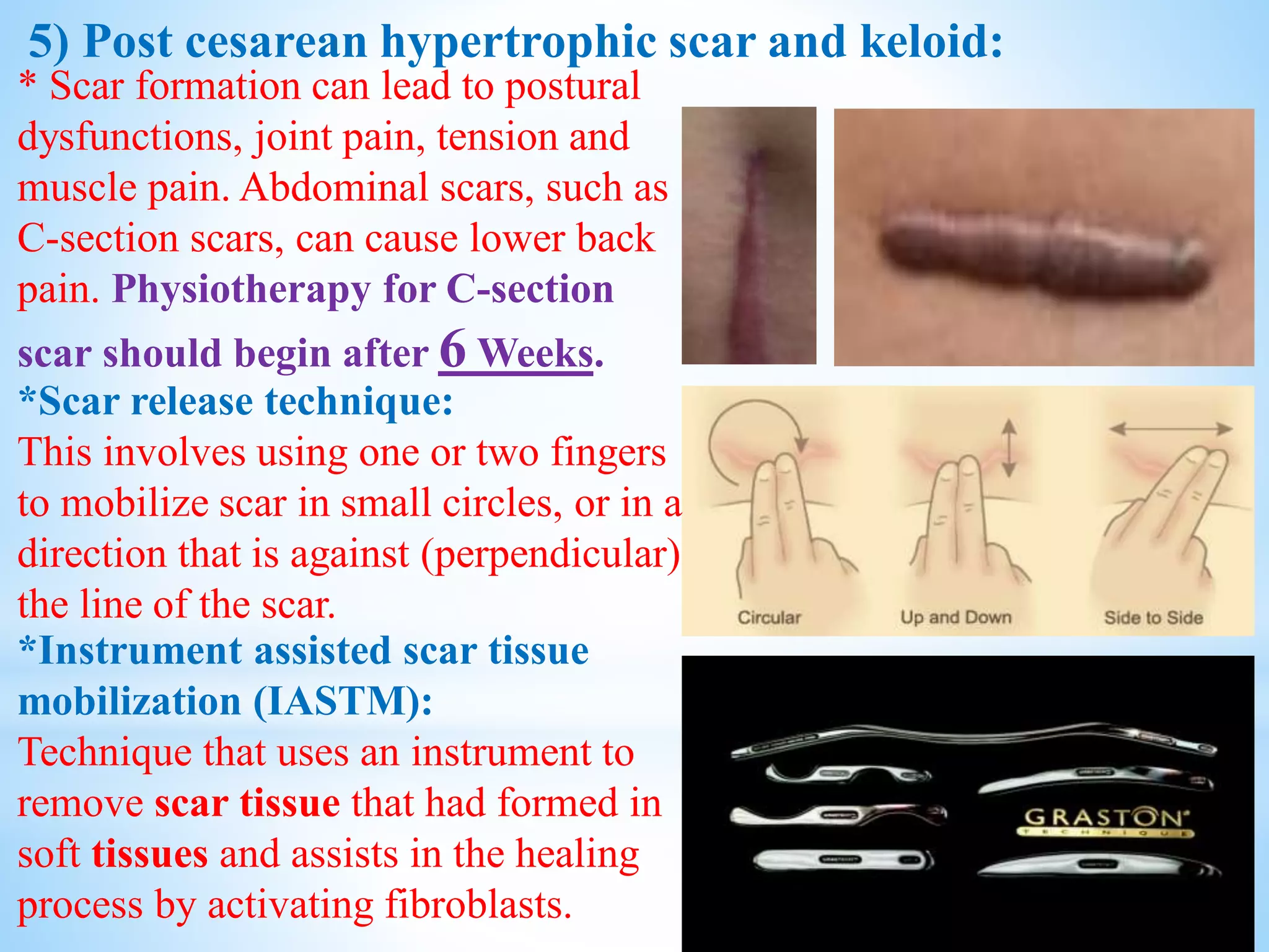 Cesarean section | PDF
