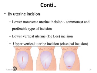 cesarean delivery for midwifery students .pptx