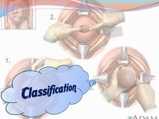 Cesarean section | PDF